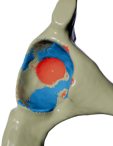 Visualization of a poorly reamed hip socket.